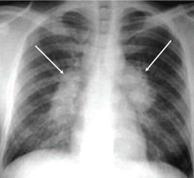 PULMONARY TUBERCULOSIS