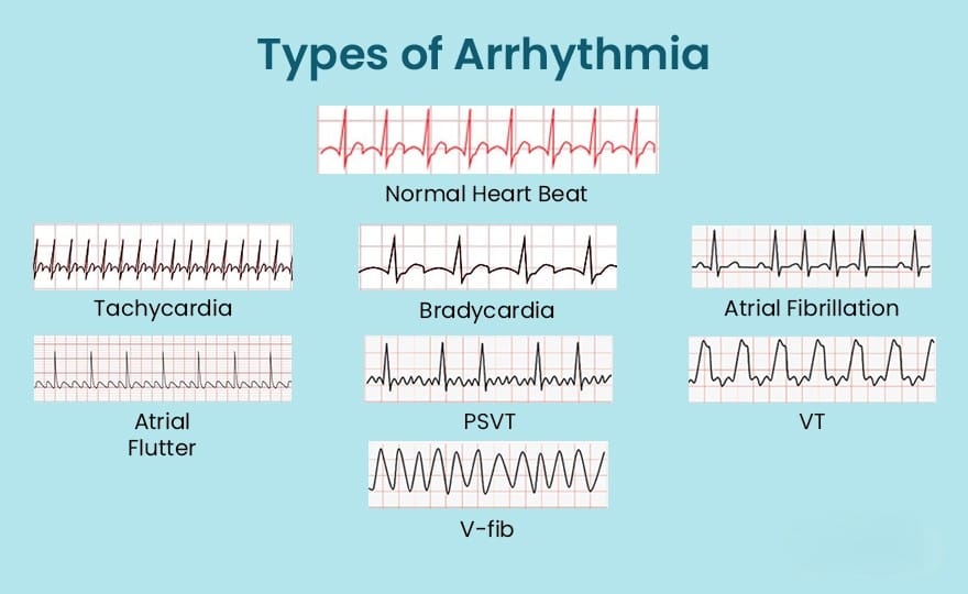Cardiac Arrhythmia: Symptoms, Causes, Diagnosis, and Treatment