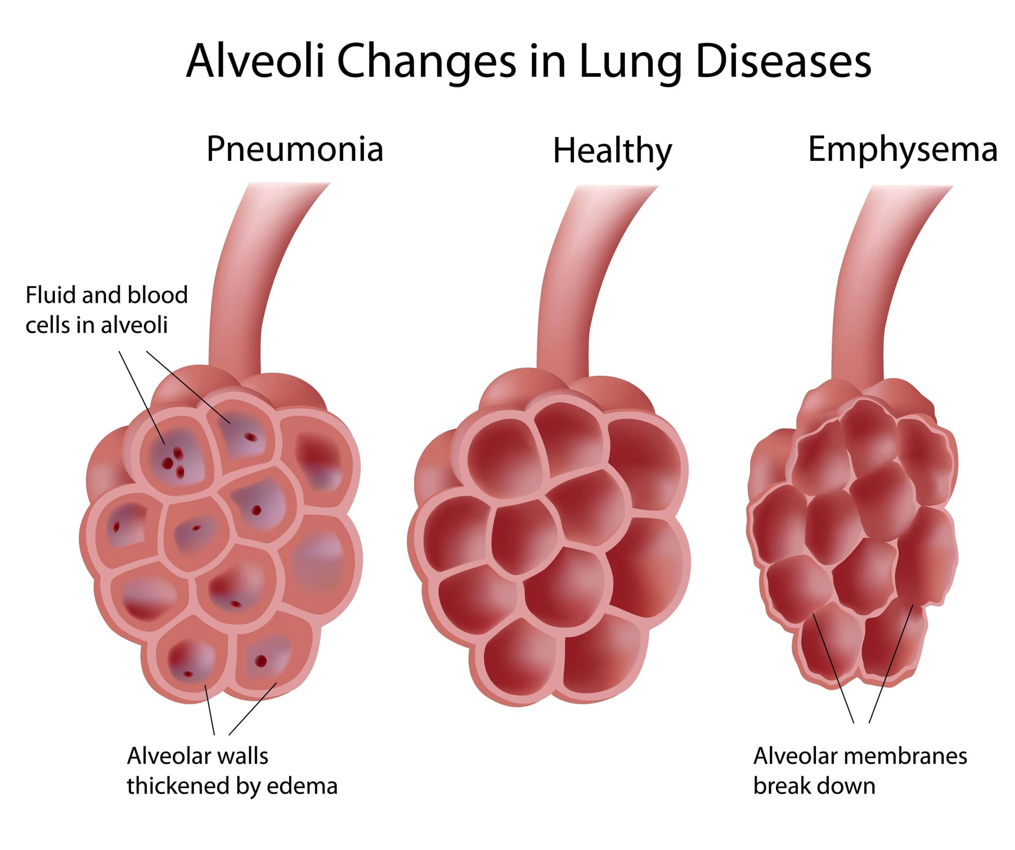 Emphysema: Symptoms, Diagnosis, and Treatment