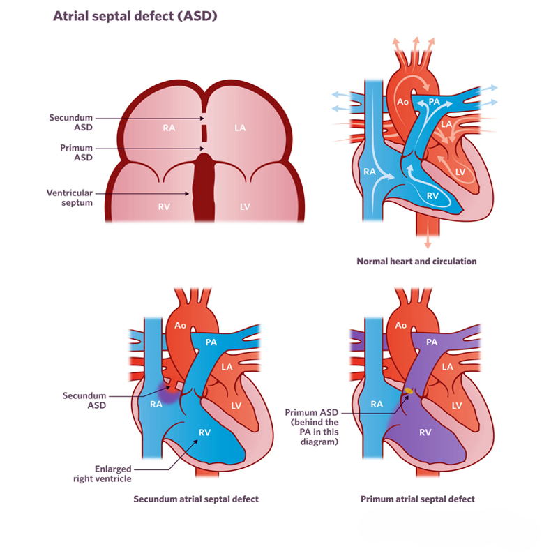 Atrial Septal Defect: Causes, Symptoms, Diagnosis, and Treatment