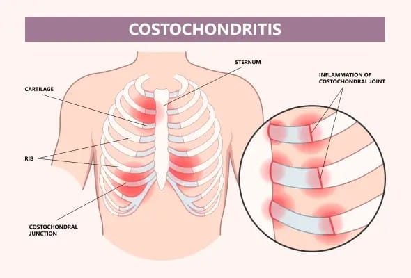 Costochondritis: Causes, Symptoms, Diagnosis, and Treatment