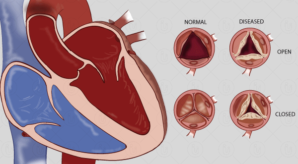 Rheumatic Heart Disease: Causes, Symptoms, Diagnosis, and Treatment