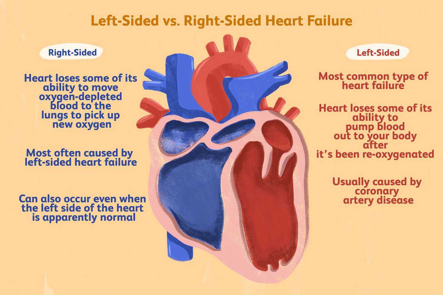 Right-Sided Heart Failure: Causes, Symptoms, Diagnosis, and Treatment