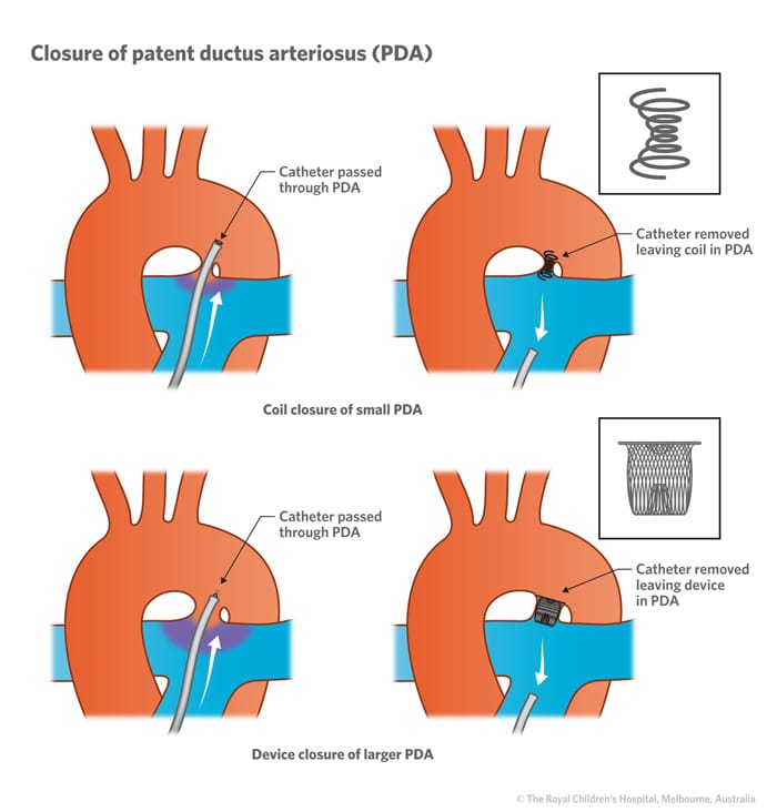 Patent Ductus Arteriosus (PDA): Causes, Symptoms, Diagnosis, and Management