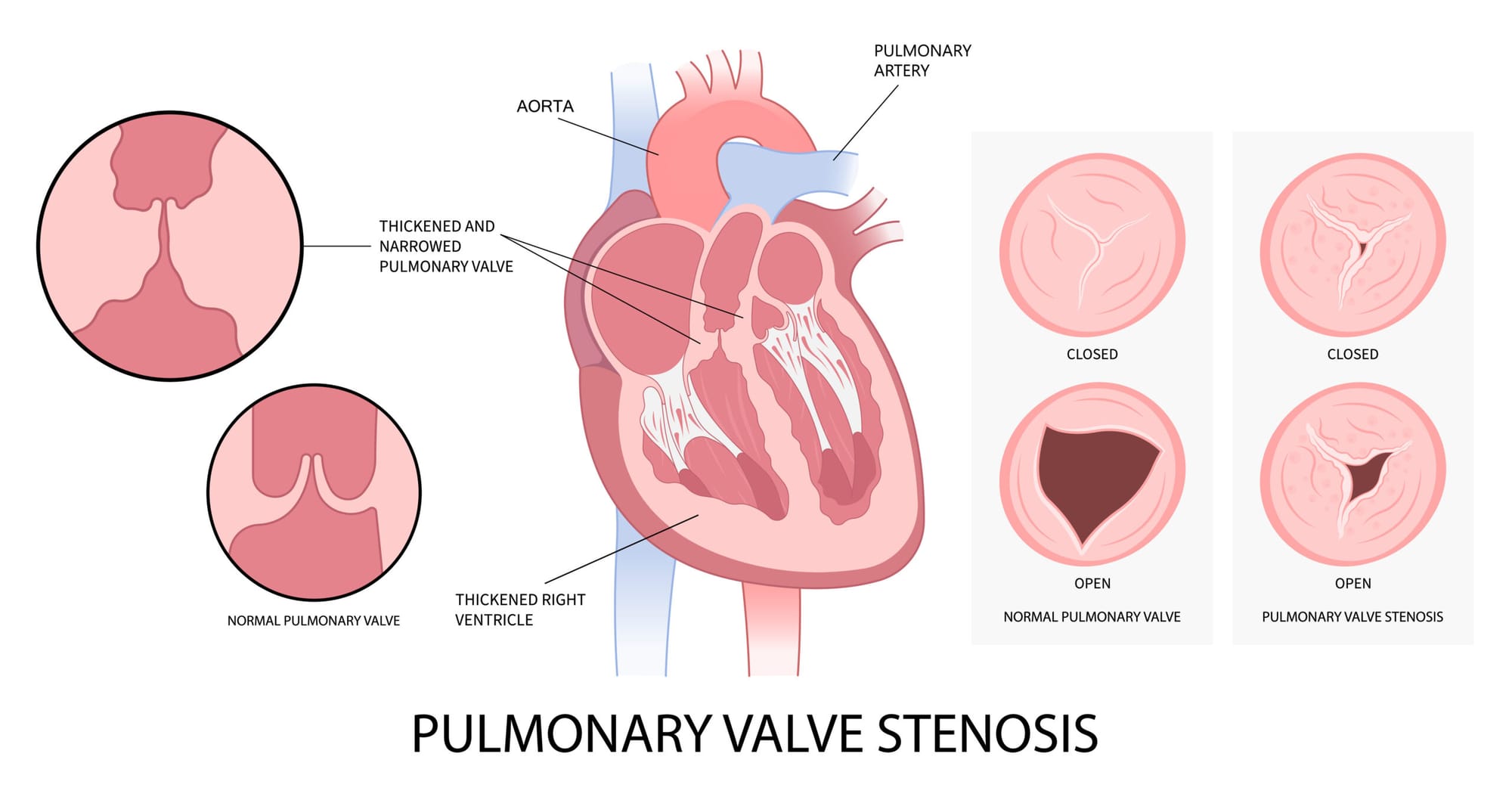 Pulmonary Valve Stenosis (PVS): Causes, Symptoms, Diagnosis, and Treatment