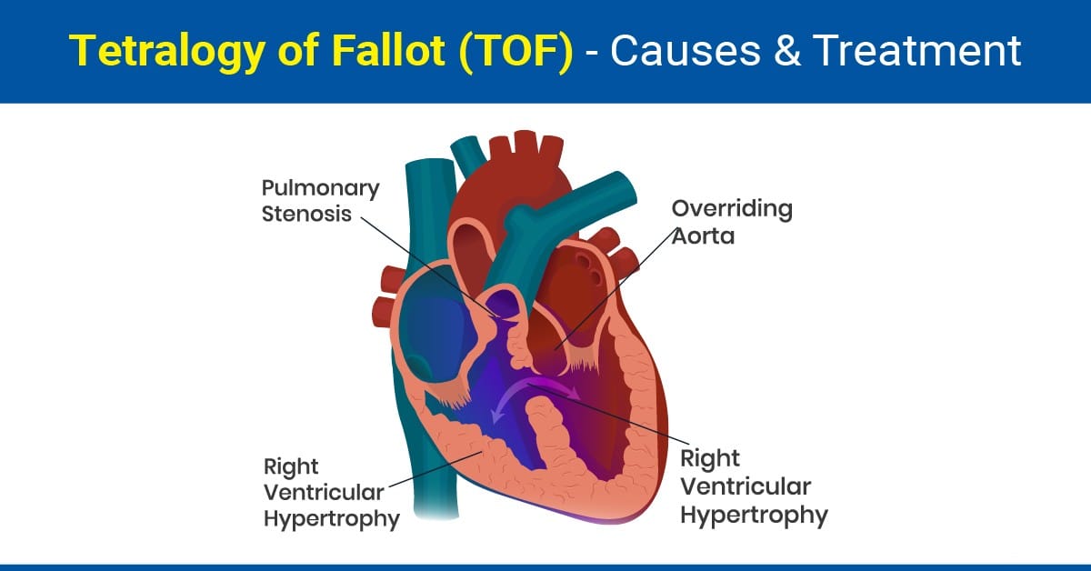 Tetralogy of Fallot: Causes, Symptoms, Diagnosis, and Treatment
