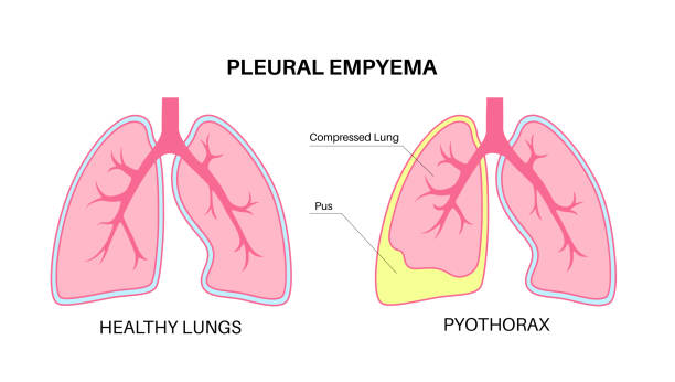 Empyema: Causes, Symptoms, Diagnosis, and Treatment