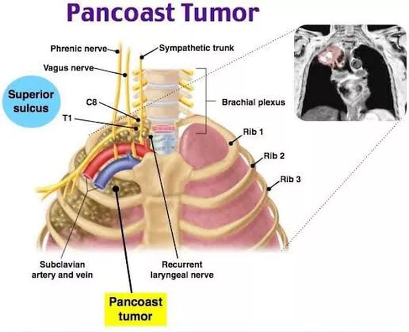 Pancoast Tumor: Causes, Diagnosis, and Treatment