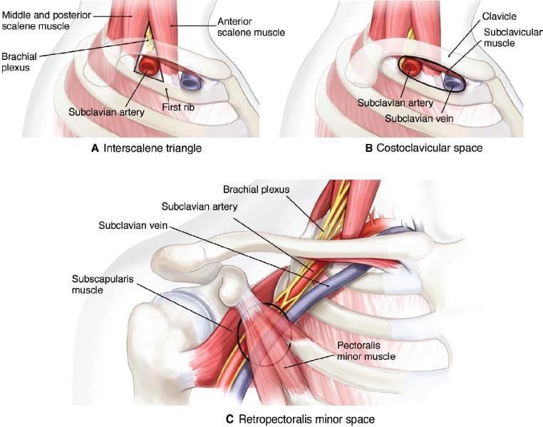 Thoracic Outlet Syndrome: Causes, Symptoms, Diagnosis, and Treatment