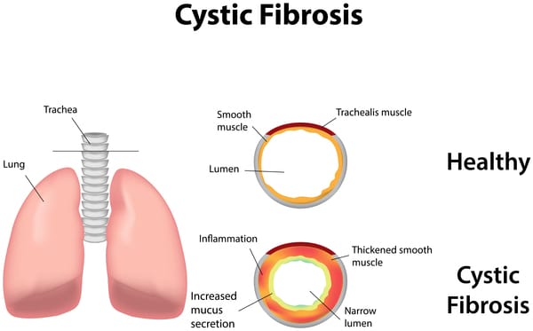 Cystic Fibrosis: Causes, Symptoms, Diagnosis, and Treatment