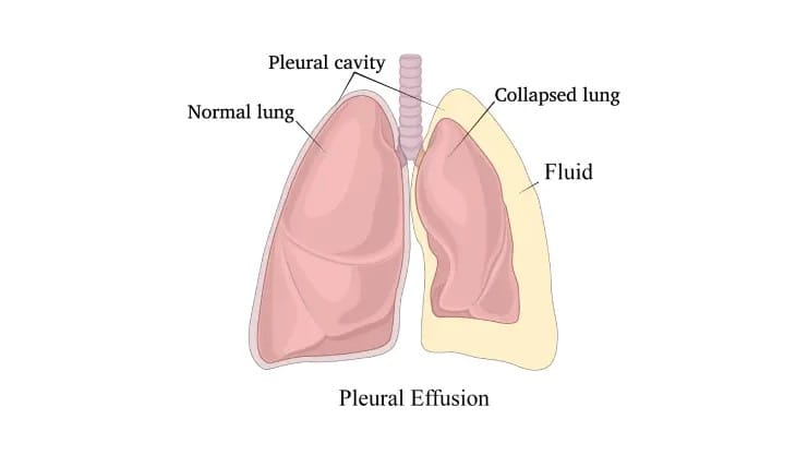 Pleural Effusion: Causes, Symptoms, Diagnosis, and Treatment