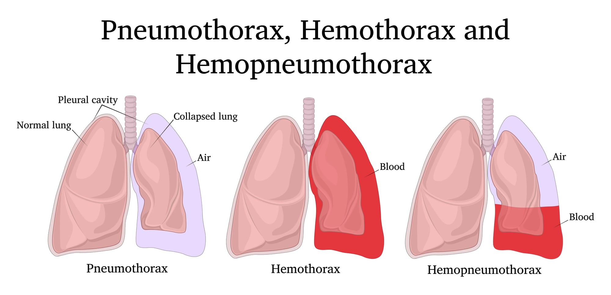 Pneumothorax: Causes, Symptoms, Diagnosis, and Treatment