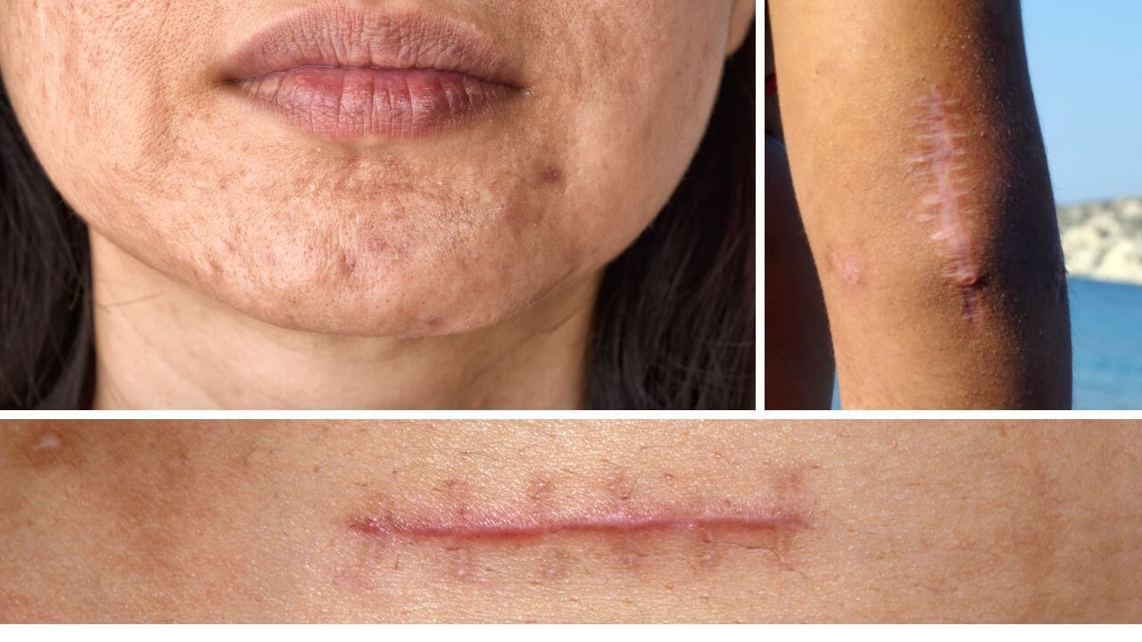 best essential oils for scars