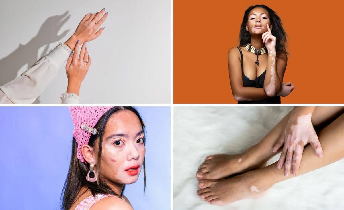 best sunscreen for vitiligo