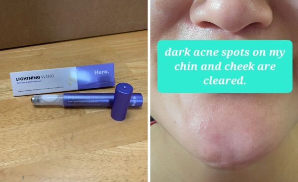 Instantly Transform Your Skin: Meet the Hero Cosmetics Lightning Wand and Say Goodbye to Post-Blemish Dark Spots!