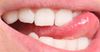 Tongue Simply Not Capable Of Dislodging Food Caught Between Teeth
