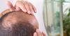 Local Man Suspects His Baldness Is God Punishing Him For Having An Undercut In The 90s