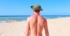 “I Don’t Get Sunburnt,” Says Local Moron About To Be Sunburnt