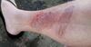 Bloke With Weeping Muffler Burn Says What Ya Wanna Do Is Go Straight To Kuta Beach