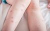 Chubby Wynnum Kid’s Midgie Bites Still Going Strong 4 Months After Moreton Camping Trip