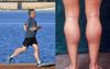 Bill Shorten Under Fire For Allegedly Spending Campaign Funds On Calf Implants