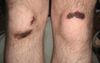 Grown Man With Scabs On Knees And Elbows Either A Skateboarder Or A Piss Wreck