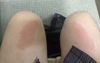 Man Returning To Desk After An Hour With Red Marks On Knees Advised To Get More Fibre In Diet