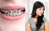 Local Woman Who Had To Suffer Through Hideous Steel Braces Stares Daggers At Little Sister’s Clear Teeth Aligners