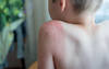 Mum Treating Mild Sunburn Like The 11th Plague Sent To Teach Her Gratitude  