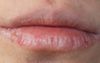 Cold Snap Leaves Dry Lip Guy’s Face Looking Like Lake Eyre