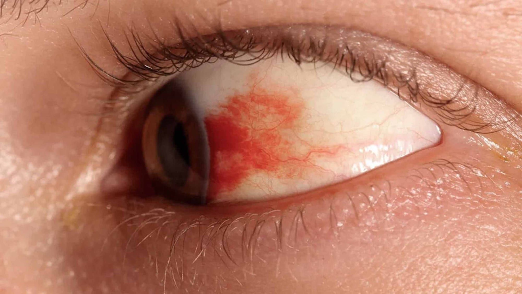Desarrolla la UNAM gotas oftálmicas para prevenir la pérdida de visión en personas con diabetes
