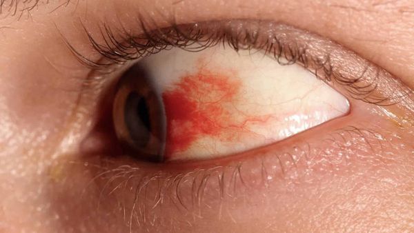 Desarrolla la UNAM gotas oftálmicas para prevenir la pérdida de visión en personas con diabetes