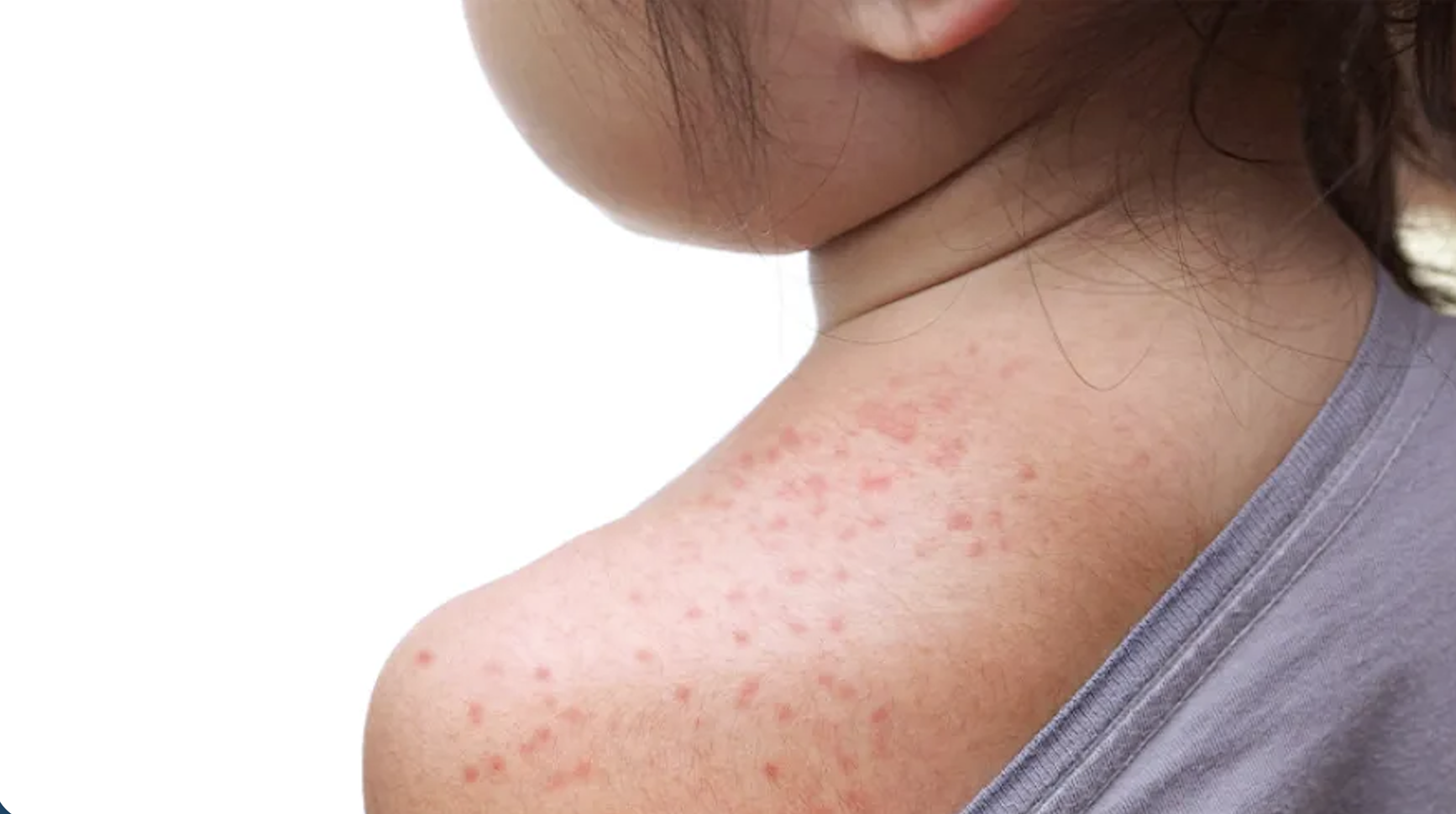 What you need to know about measles  post image