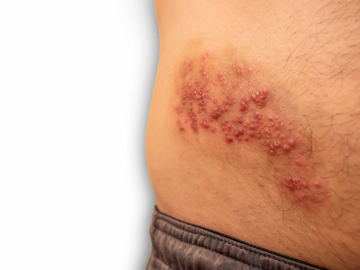 What you should know about shingles
