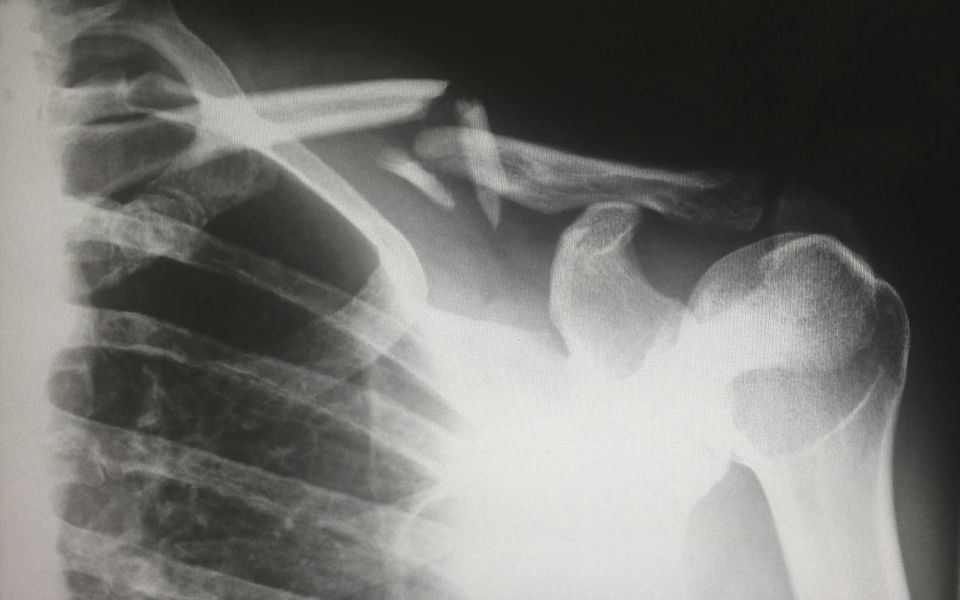Section B: Rehab after fracture