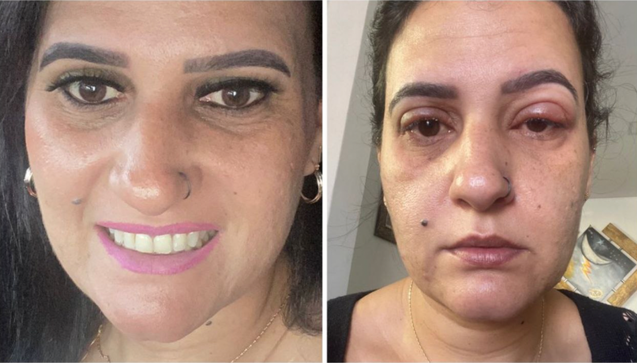 Termina hospitalizada mujer brasileña por pestañas postizas