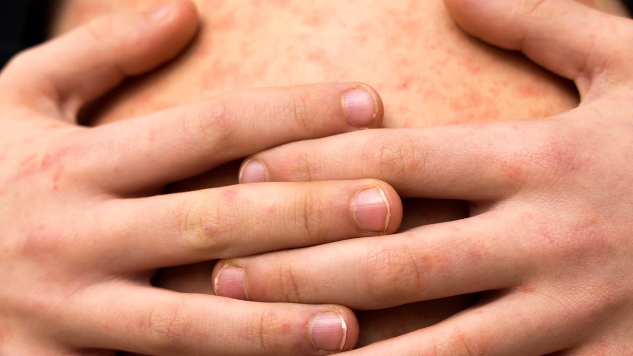 Esto sabemos sobre el brote de sarampión en México: ¿deberías preocuparte?