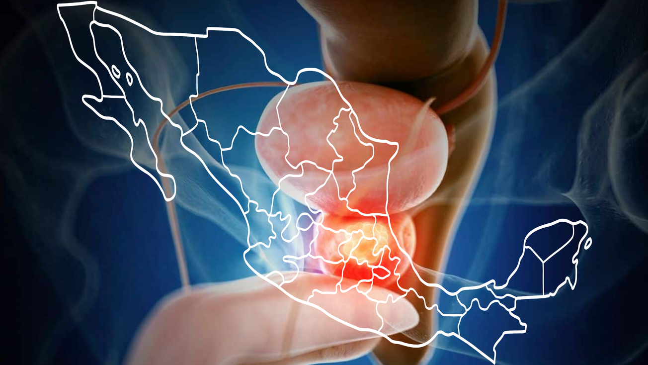 Se detectan 3 casos por hora de cáncer de próstata en México
