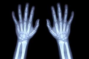 Estimer l’âge d’un mineur par radiographie peut se révéler discriminatoire