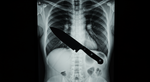 The Blade That Slept: How a Man Lived Eight Years with a Knife in His Chest