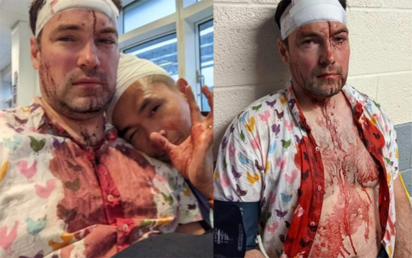 Gay couple left bloodied and beaten in horrendous homophobic attack in Birmingham’s Gay Village