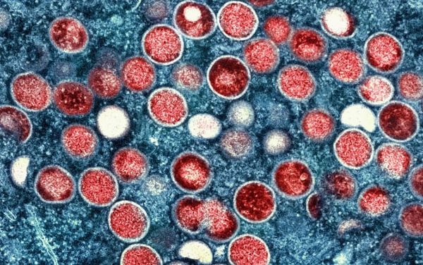 Race for monkeypox vaccines exposes global health inequality