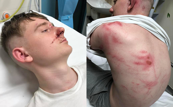 Teen viciously attacked by 10 homophobes with knuckle dusters after defending friend