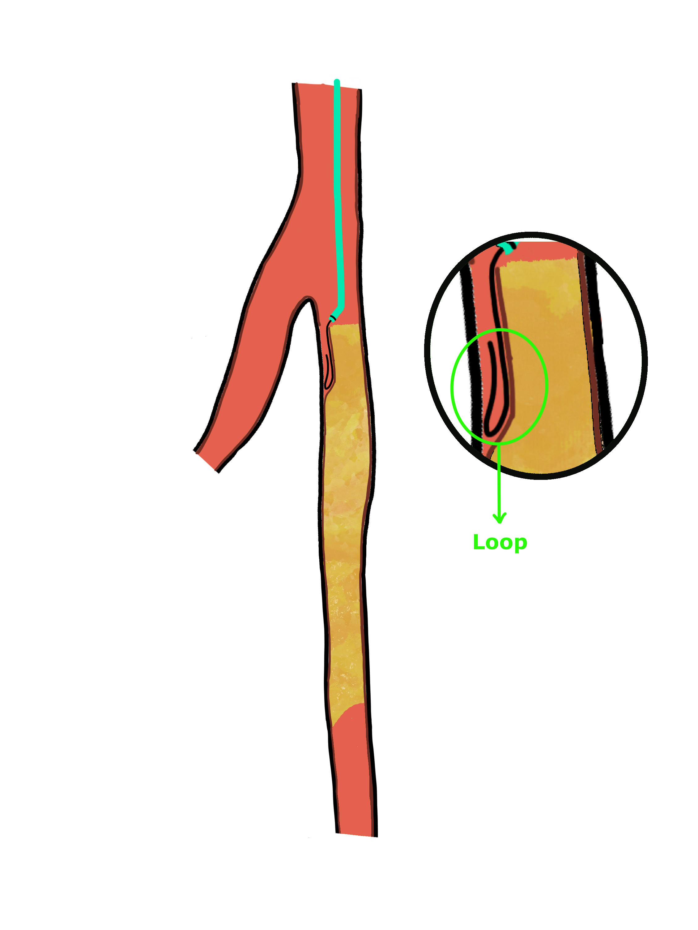 Schematic of a femoropopliteal CTO with a guidewire entering the subintimal plane at the proximal cap, with magnified inset showing the loop at the wire tip.
