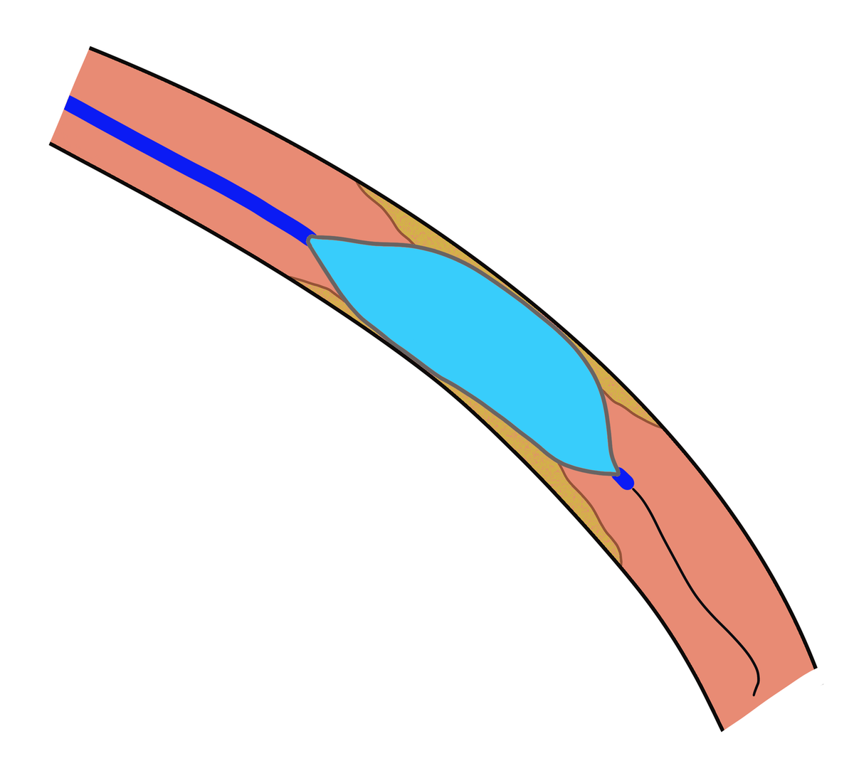 Post-Angioplasty Dissection Management: Bailout Strategies