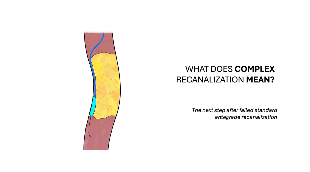 What Does Infrainguinal “Complex Recanalization” Really Mean?