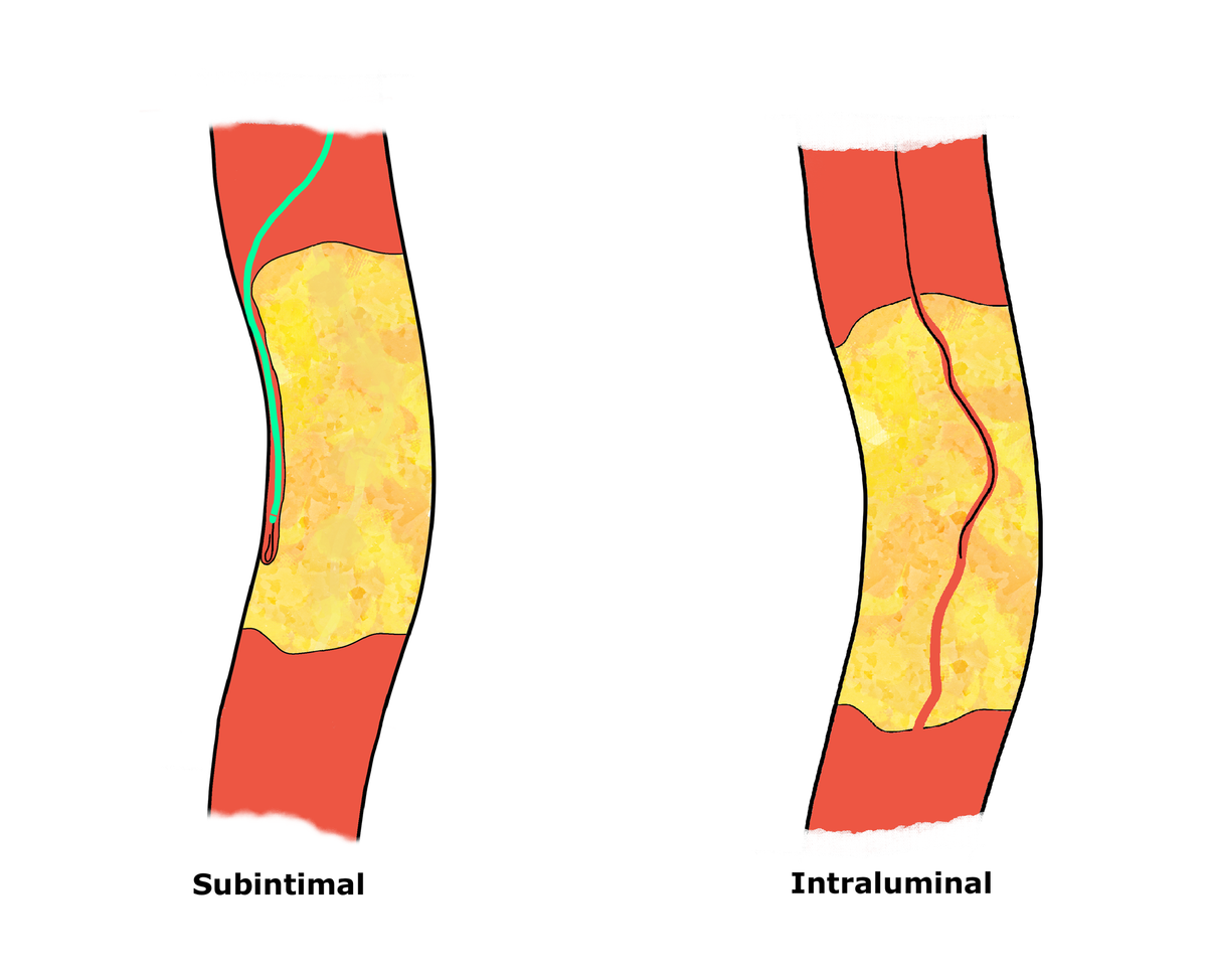 Side-by-side schematic of two crossing strategies for a long femoropopliteal CTO: subintimal (left), guidewire looping between plaque and wall; intraluminal (right), wire through the plaque.