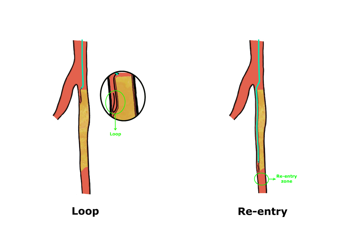 Side-by-side schematic of subintimal recanalization: the guidewire loop at the proximal cap (left) and the re-entry zone at the distal cap (right) of a long femoropopliteal CTO.