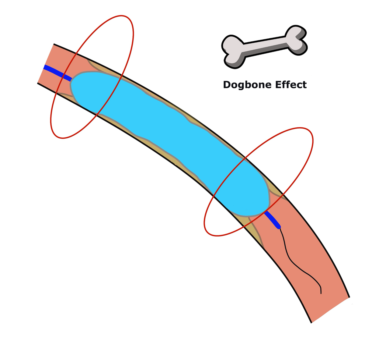Illustration of balloon angioplasty in a peripheral artery: inflated balloon across a plaque, with the two balloon ends on healthier wall circled in red — the dogbone effect