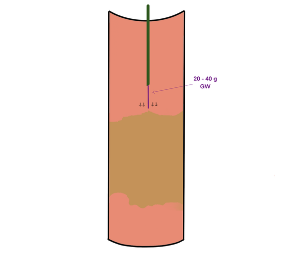 The Utility of the Perforating Technique in Infrainguinal CTO Recanalization